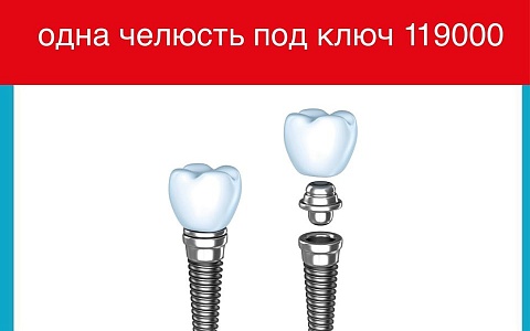 Восстановление всех зубов по системе All-on-4